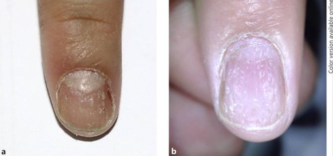 孩子指甲軟薄易斷、月牙少、長(zhǎng)白點(diǎn)、豎紋是顯示身體有健康風(fēng)險(xiǎn)嗎？(圖7)