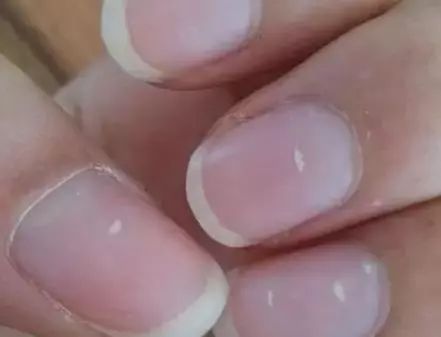 孩子指甲軟薄易斷、月牙少、長(zhǎng)白點(diǎn)、豎紋是顯示身體有健康風(fēng)險(xiǎn)嗎？(圖6)