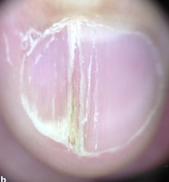 孩子指甲軟薄易斷、月牙少、長(zhǎng)白點(diǎn)、豎紋是顯示身體有健康風(fēng)險(xiǎn)嗎？(圖11)