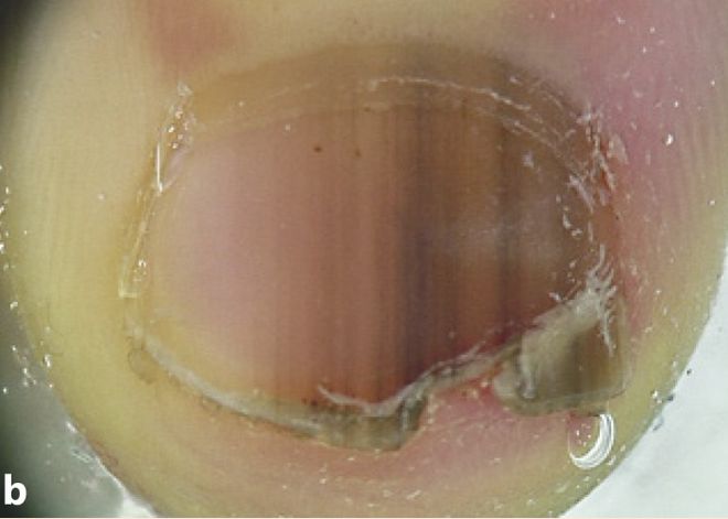 孩子指甲軟薄易斷、月牙少、長(zhǎng)白點(diǎn)、豎紋是顯示身體有健康風(fēng)險(xiǎn)嗎？(圖8)