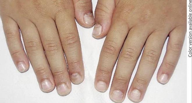 孩子指甲軟薄易斷、月牙少、長(zhǎng)白點(diǎn)、豎紋是顯示身體有健康風(fēng)險(xiǎn)嗎？(圖10)