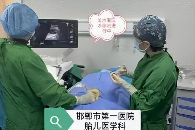 【邯鄲首例】邯鄲市第一醫(yī)院成功實(shí)施胎兒羊水灌注術(shù)(圖2)